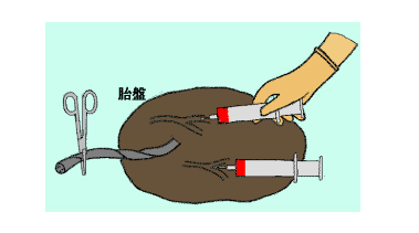 臍帶血造血干細(xì)胞的采取方法